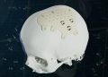 Materialise, kişiye özel PEEK implantlarla CMF portföyünü genişletiyor